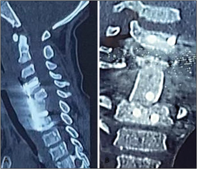 Successful Management of Traumatic Cervical Spondyloptosis with Incomplete Neurological Deficit in a Child: A Case Report.