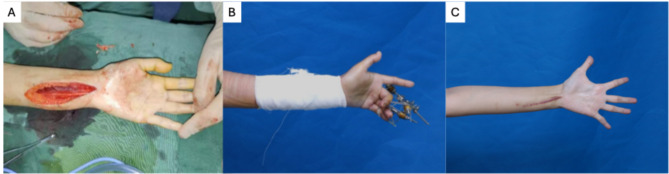 Ulnar nerve entrapment syndrome: a special case report.