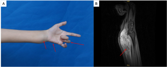 Ulnar nerve entrapment syndrome: a special case report.