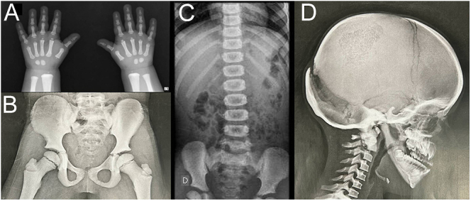 From genotype to phenotype: the impact of early management in pycnodysostosis.