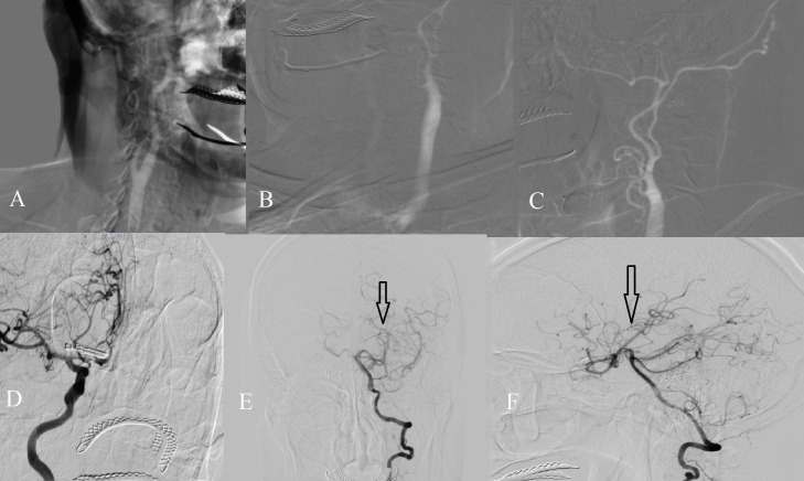 Ruptured anterior communicating artery aneurysm associated with internal carotid artery absence.