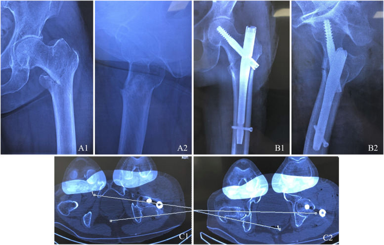 Incidence and Risk Factors for Femoral Malrotation Following Intramedullary Nailing of Trochanteric Fractures: A CT-Based Analysis.