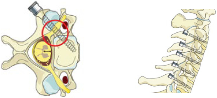 Morphometric Analysis of Subaxial Cervical Vertebra Pedicles in the Turkish Population.