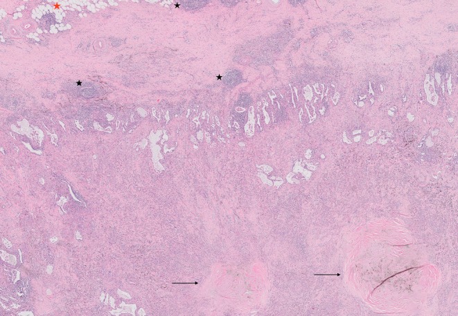 Silicosis Mimicking Lung Malignancy: A Case Series.