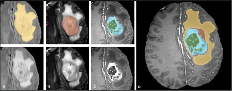 Brain tumor segmentation using deep learning: high performance with minimized MRI data.