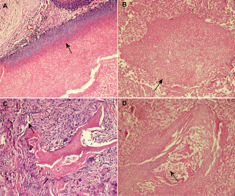 Clinical Features, Diagnostic Challenges, and Therapeutic Outcomes of 105 Pilomatricoma Cases.