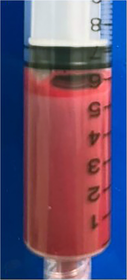 Severe hypertriglyceridaemia with length-related small fibre sensory neuropathy as a complication of previous gestational diabetes mellitus.