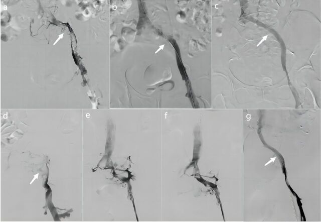 Clinical efficacy of simultaneous versus staged stent implantation after percutaneous mechanical thrombectomy in IVCS patients with acute IFDVT.