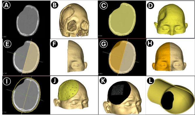 A personalized 3D printed cranial shield using mirror-image modeling: design and clinical assessment.