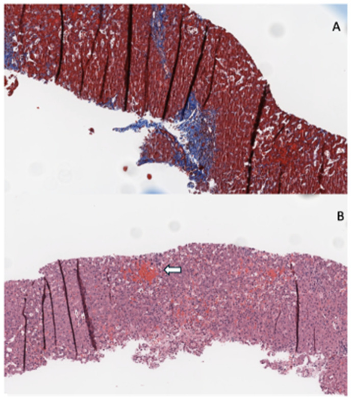 The Heart of the Matter: A Case of Massive Pedal Edema Erroneously Attributed to Liver Cirrhosis.