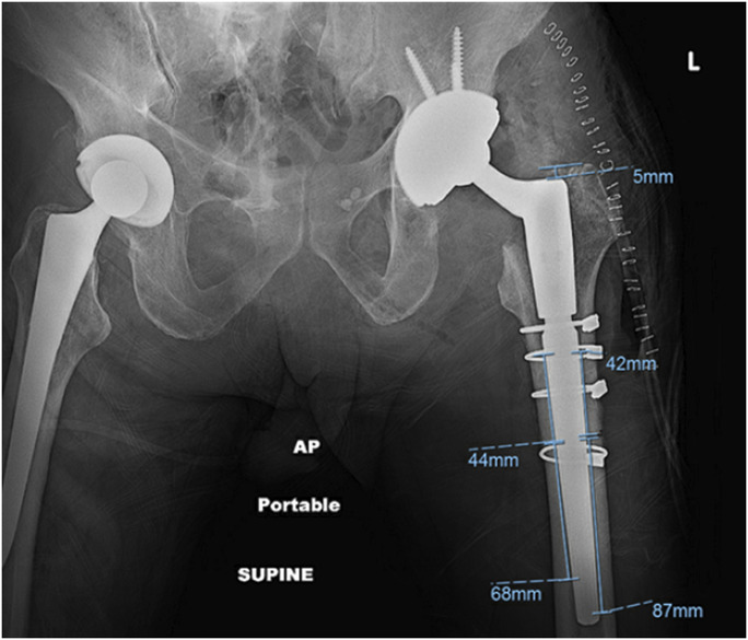 Extended Trochanteric Osteotomy Increases the Risk of Tapered Splined Stem Subsidence in Revision Total Hip Arthroplasty.