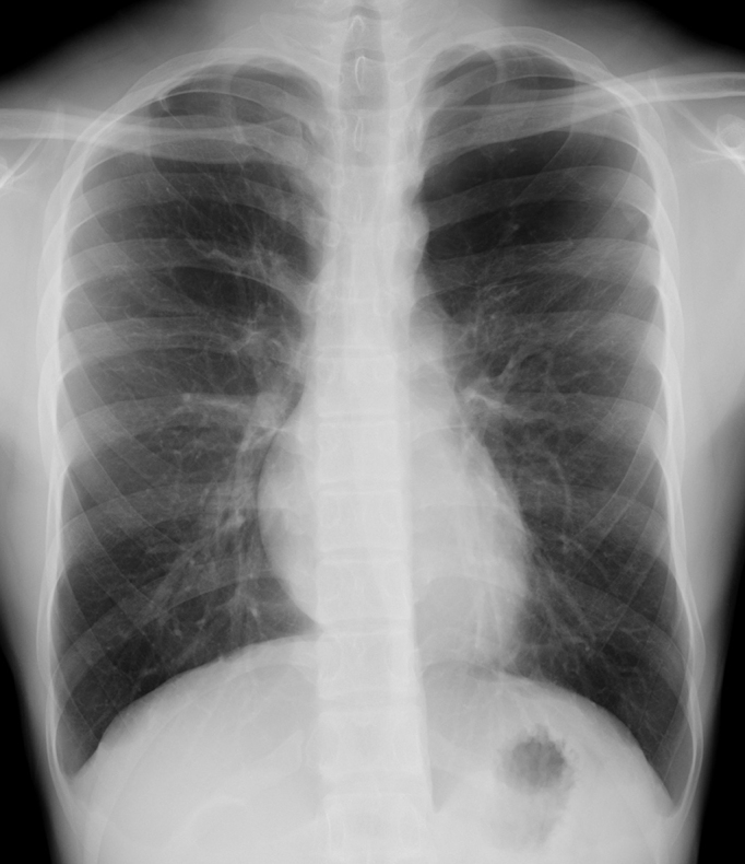 A Case of Asymptomatic Juvenile Emphysema.