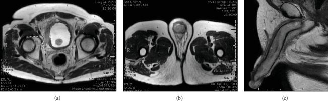 A Case of Malignant Priapism Secondary to Muscle Invasive Bladder Cancer and Review of Palliative Management.