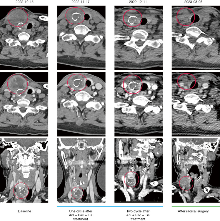 Neoadjuvant therapy and surgical resection successfully treating primary thyroid squamous cell carcinoma: a case report.