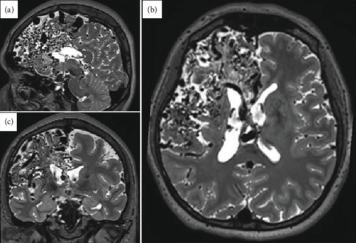 Epilepsy Secondary to a Giant AVM: A Case Report.