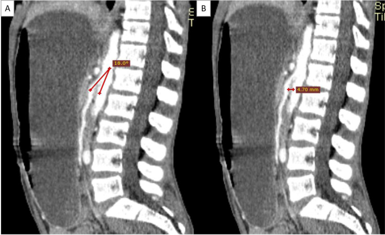 Combined Superior Mesenteric Artery Syndrome and Nutcracker Syndrome in a Young Male Patient Presenting as Atypical Vomiting and Rapid Weight Loss: A Case Report.