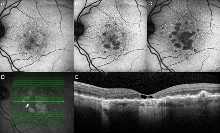 Consideration of patient phenotypes in geographic atrophy due to age-related macular degeneration.
