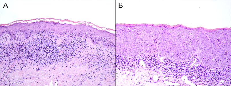 Risk of Vulvar HSIL and Penile Neoplasias in Anogenital Lichen Planus: A Case-Control Study.