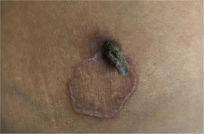 Development of a Cutaneous Horn on a Lower Extremity with Granuloma Annulare: A Rare Co-Occurrence.
