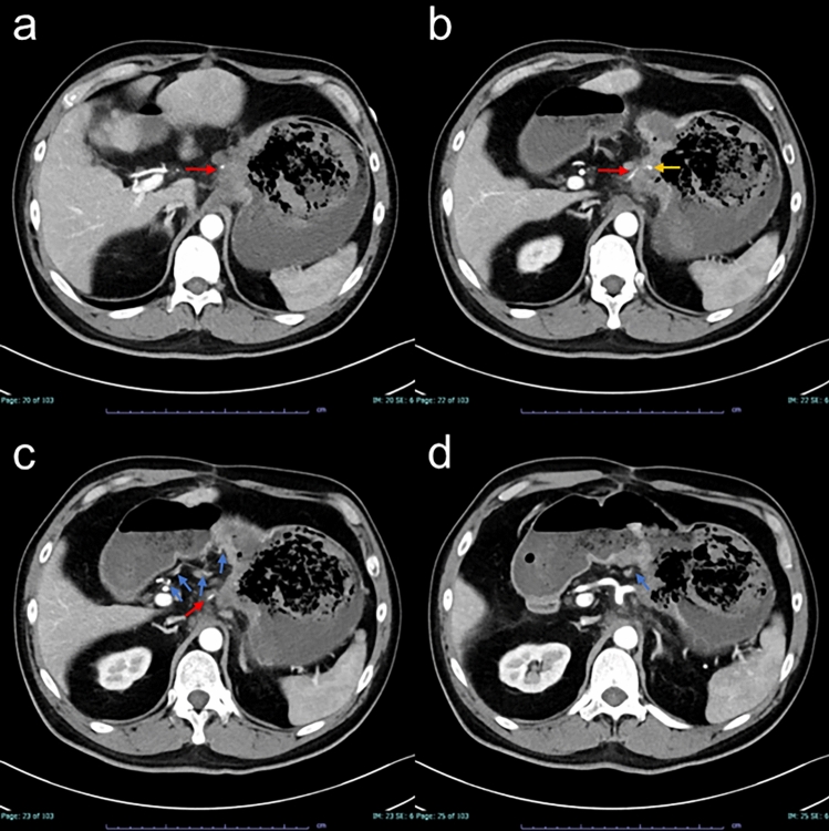 Early angiographic changes after hemostatic radiotherapy for gastric cancer bleeding, mentioning the mechanism and potential immediate effects of the treatment.