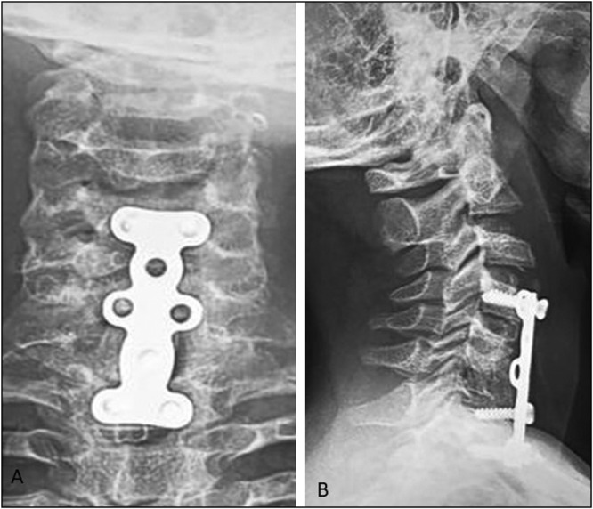 Successful Management of Traumatic Cervical Spondyloptosis with Incomplete Neurological Deficit in a Child: A Case Report.