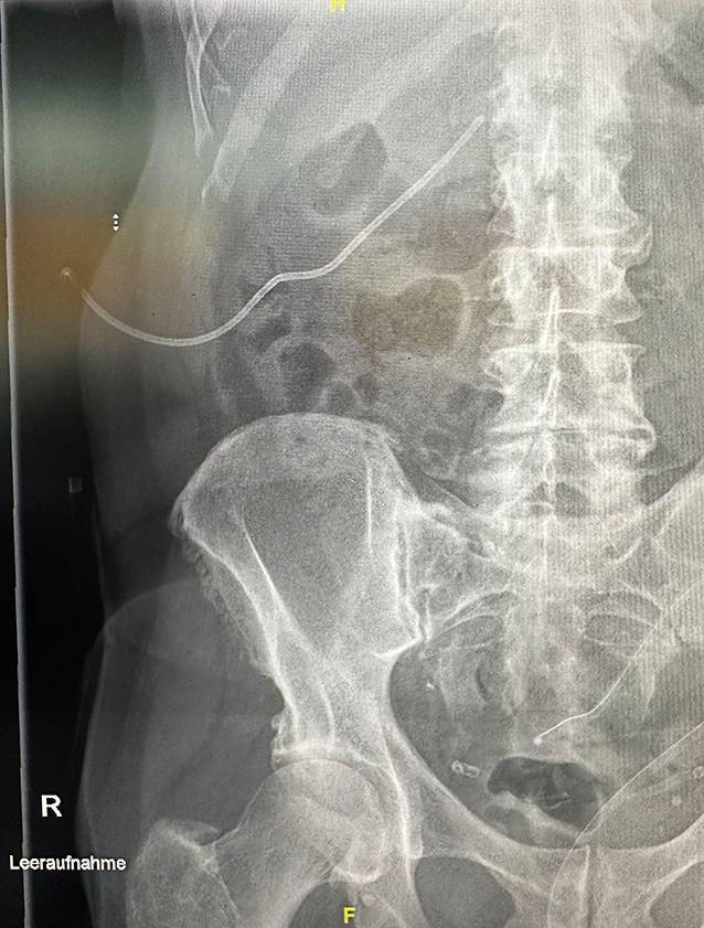 [Presentation of a new pre-emptive endoscopic treatment concept in duodenal interventions exemplified by an iatrogenic duodenal perforation after percutaneous transrenal nephrostomy. German version].