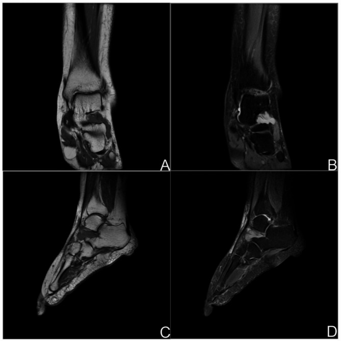 A case of primary tarsal sinus synovial sarcoma.