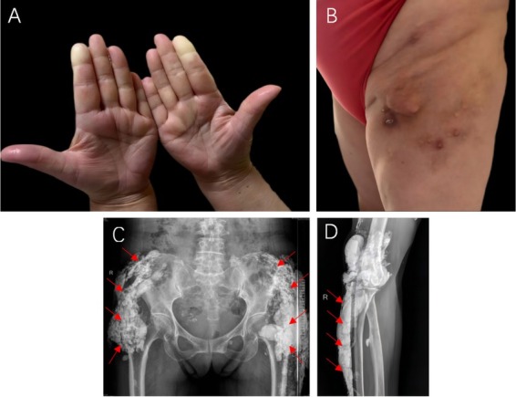 Medusas petrifying gaze: Severe, diffused and refractory calcinosis from a patient with ACA-negative CREST syndrome.