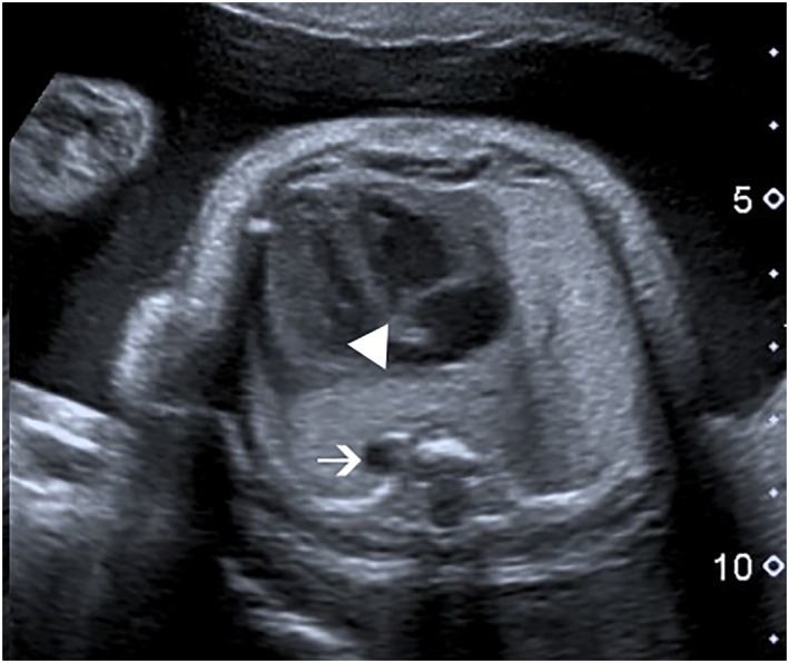 Prenatal Diagnosis of Horseshoe Lung: A Report of Three Cases and Review of the Literature.