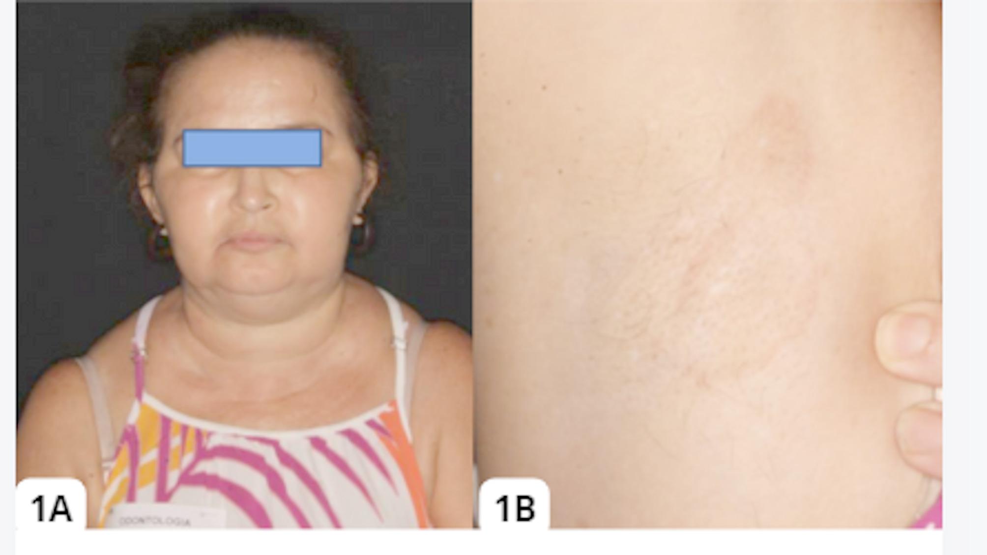 Vegetative pyodermatitis-pyostomatitis in a patient with Crohn's disease: a clinical case report.