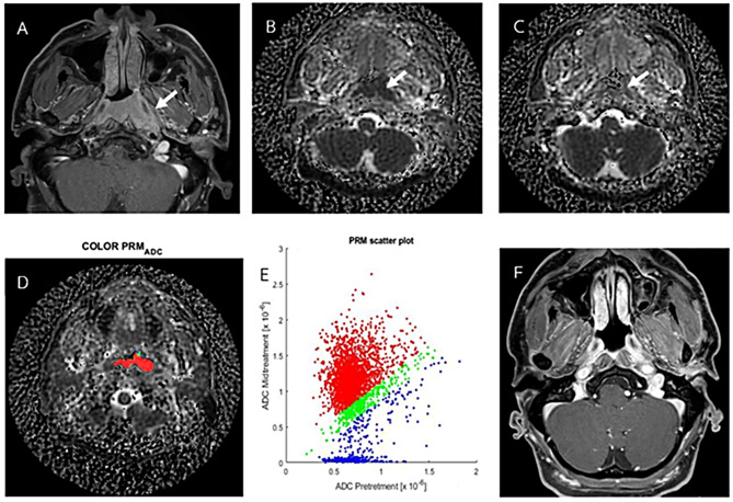 The use of diffusion-weighted magnetic resonance imaging and parametric response mapping for disease outcome prediction in nasopharyngeal carcinoma.