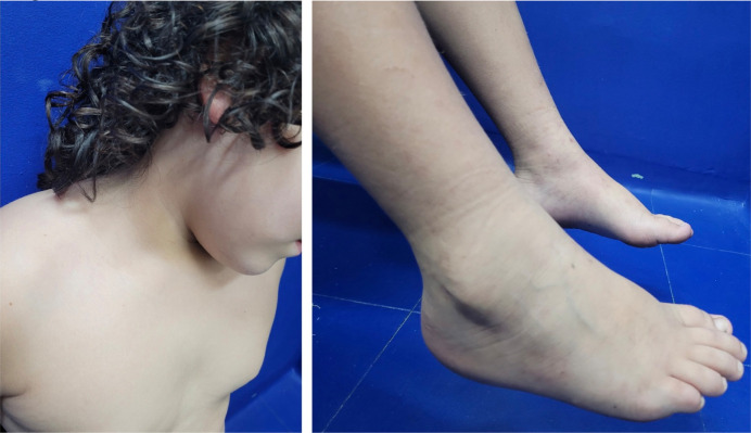 Multi systemic compromise due to Bartonella henselae in a child.