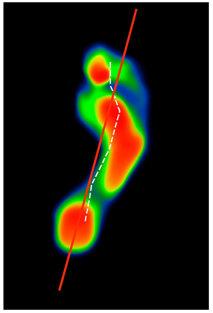 Forefoot Centre of Pressure Patterns in Black Male African Recreational Runners with Pes Planus.