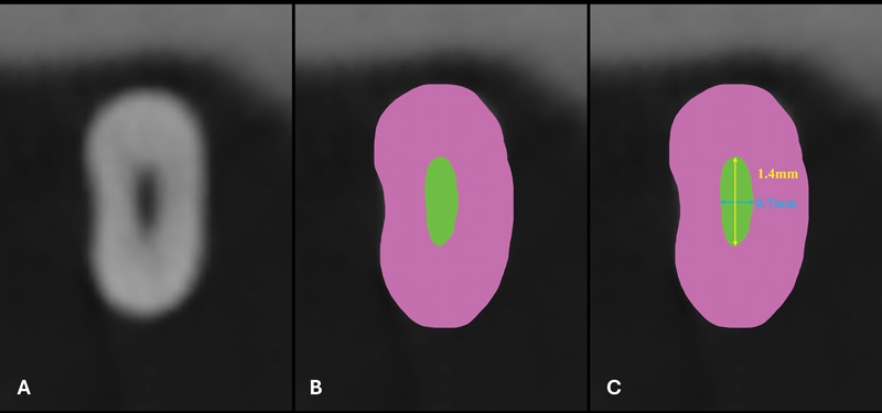 Effect of Apical Preparation Size and Preparation Taper on Smear Layer Removal Using Two Different Irrigation Needles: A Scanning Electron Microscopy Study.