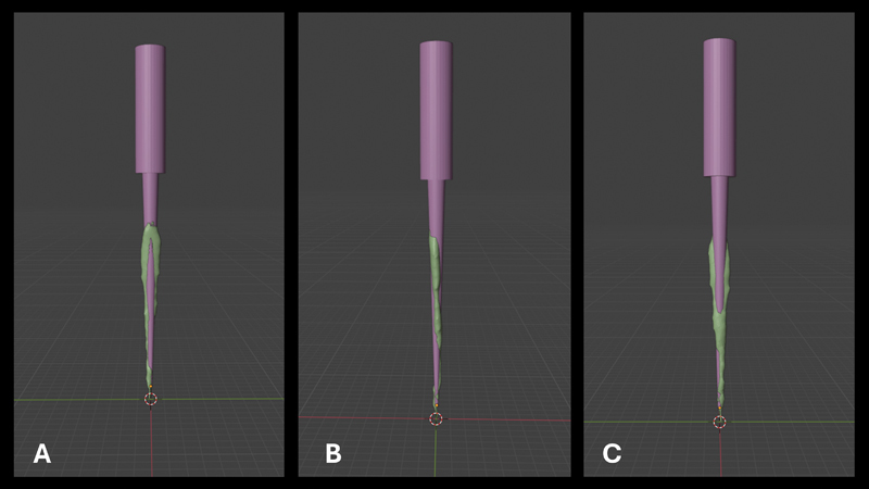Effect of Apical Preparation Size and Preparation Taper on Smear Layer Removal Using Two Different Irrigation Needles: A Scanning Electron Microscopy Study.