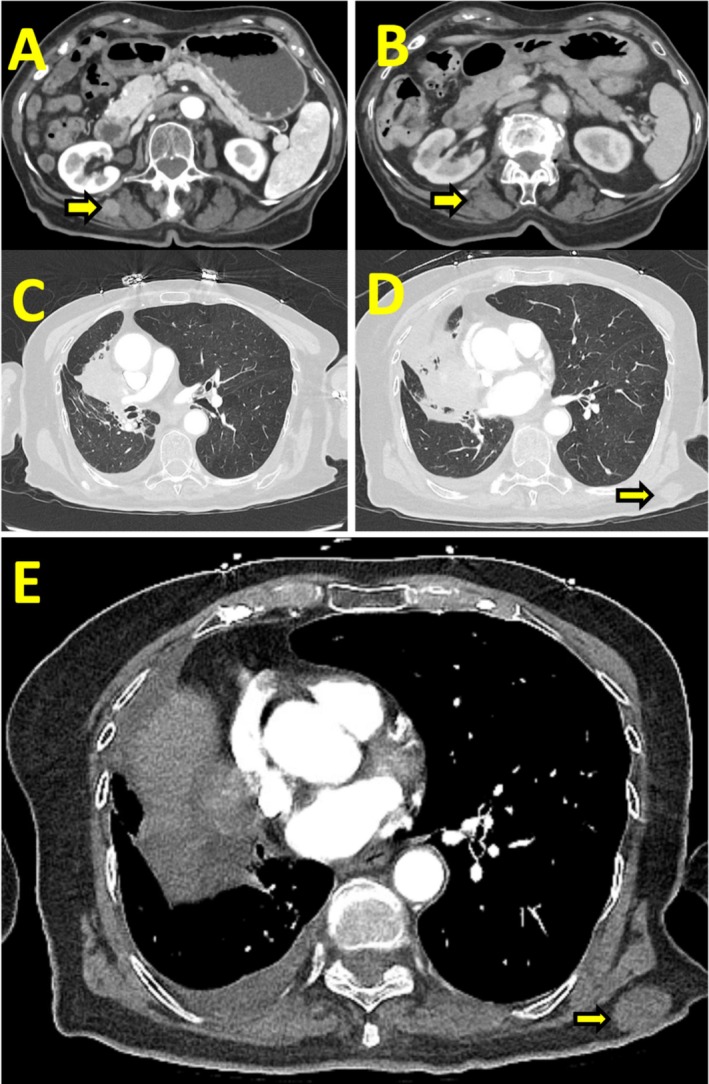 Primary Pulmonary Leiomyosarcoma: A Case of Prolonged Survival With Radiotherapy and Pazopanib in a 90-Year-Old Female.