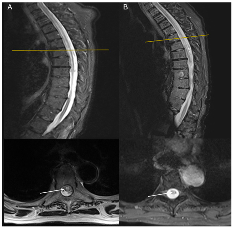 Neuromyelitis Optica Diagnosis in Two Elderly Patients with Systematic Lupus Erythematosus: A Case Series.