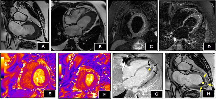 Clinical Images: Löffler endocarditis: a rare cardiac manifestation of eosinophilic granulomatosis with polyangiitis.