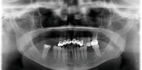 Implant Osseointegration Adjacent to a Retained Root Fragment: A Case With 11-Year Follow-up.