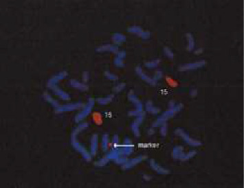 Paternal UPD (15) With Disease-Causing Mutation and Small Supernumerary Ring Chromosome 15: A Case Report.
