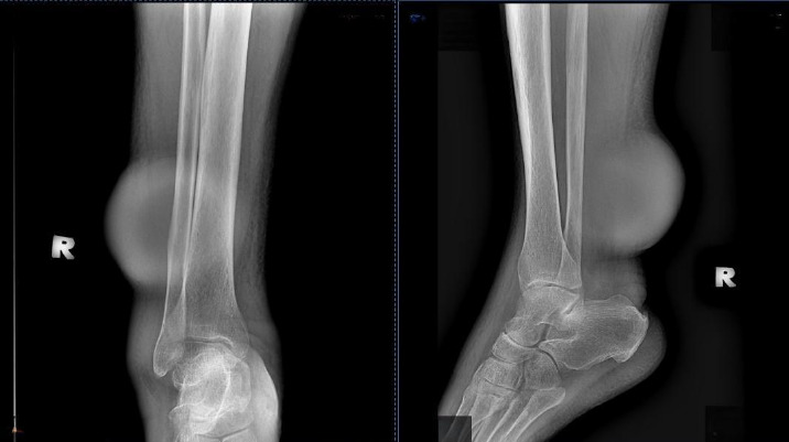 Lymphoedema - Filariasis or soft tissue sarcoma? A case report.