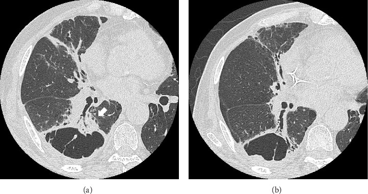 Small-Cell Lung Carcinoma Associated With Cystic Airspaces: A Case Report.