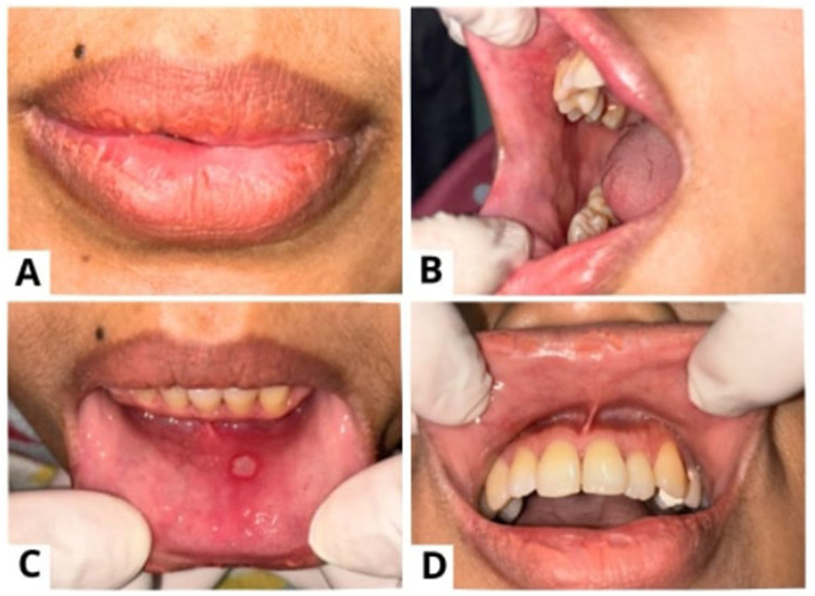 Identifying the Multifactorial Triggers of Monthly Recurrent HSV-1 Reactivation: A Case Report.