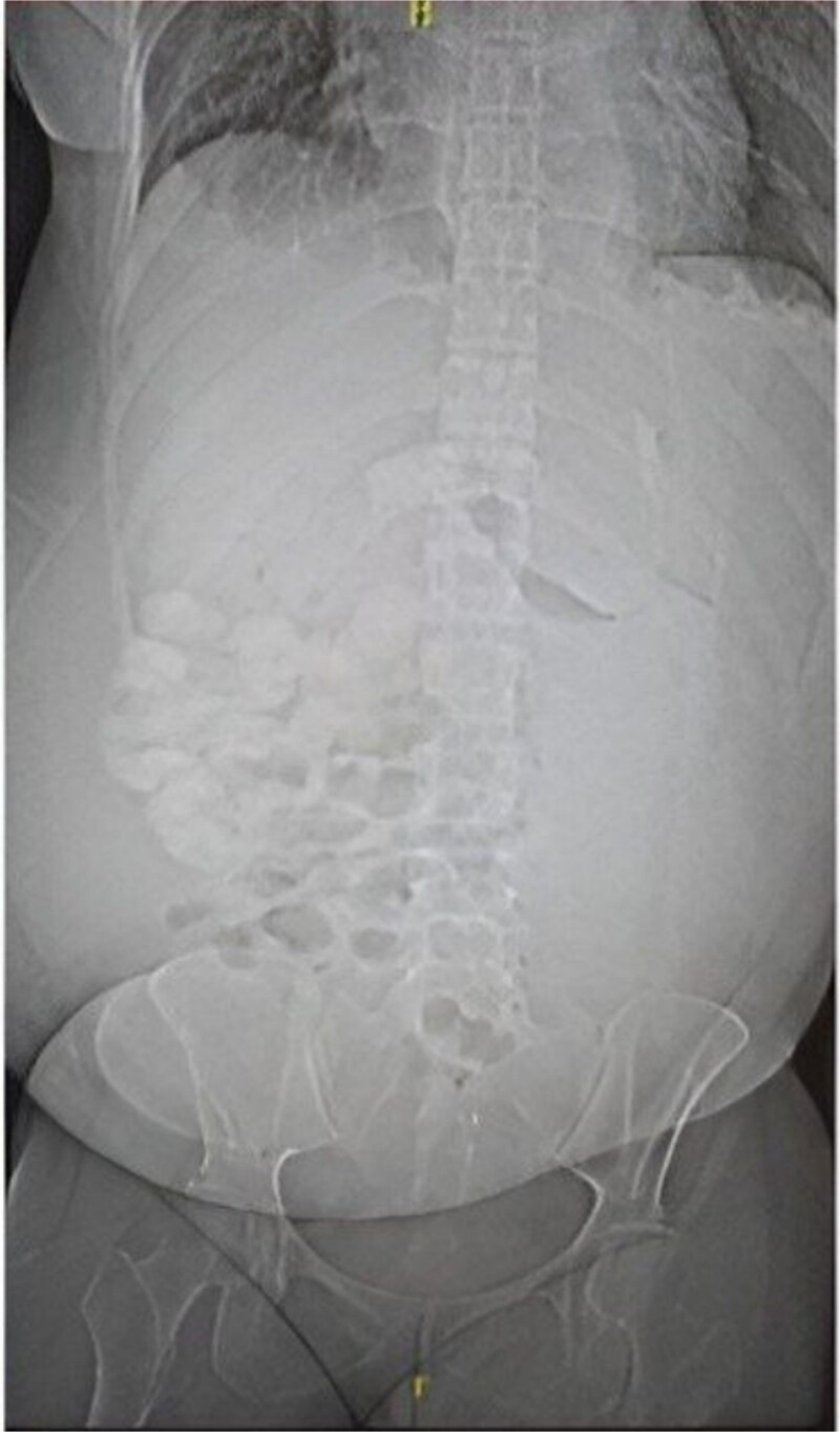 Catastrophic antiphospholipid syndrome in a young patient: a case report of severe multi-organ and cardiovascular involvement.