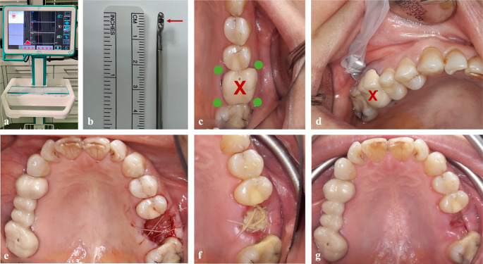 Effect of platelet-rich fibrin on microperfusion during early socket healing: a randomized controlled clinical trial.