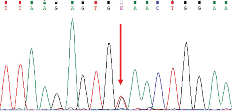 A novel pathogenic variant in the fibrinogen gamma chain gene p.Glu275Lys causes congenital hypofibrinogenemia.