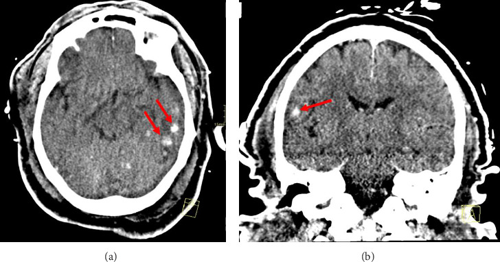Secondary Dengue Infection Complicated by Hemophagocytic Lymphohistiocytosis: A Case Report.
