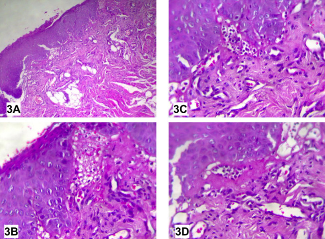 Vegetative pyodermatitis-pyostomatitis in a patient with Crohn's disease: a clinical case report.