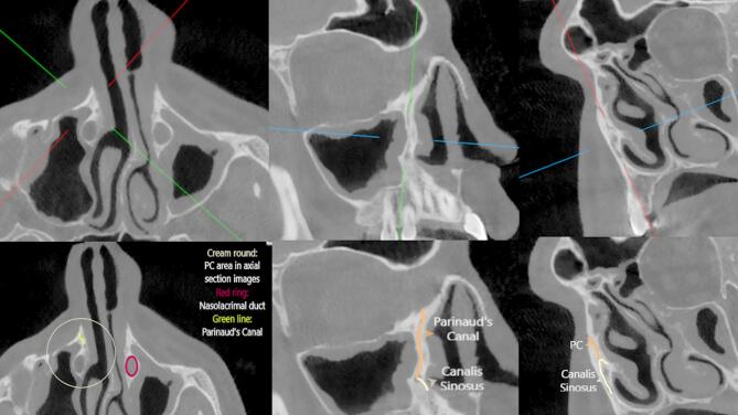Evaluation of a rare known anatomic formation: Parinaud's canal.