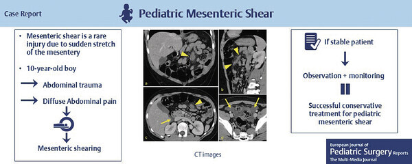 Mesenteric Shearing in a Pediatric Patient, Successfully Managed Conservatively: A Case Report.